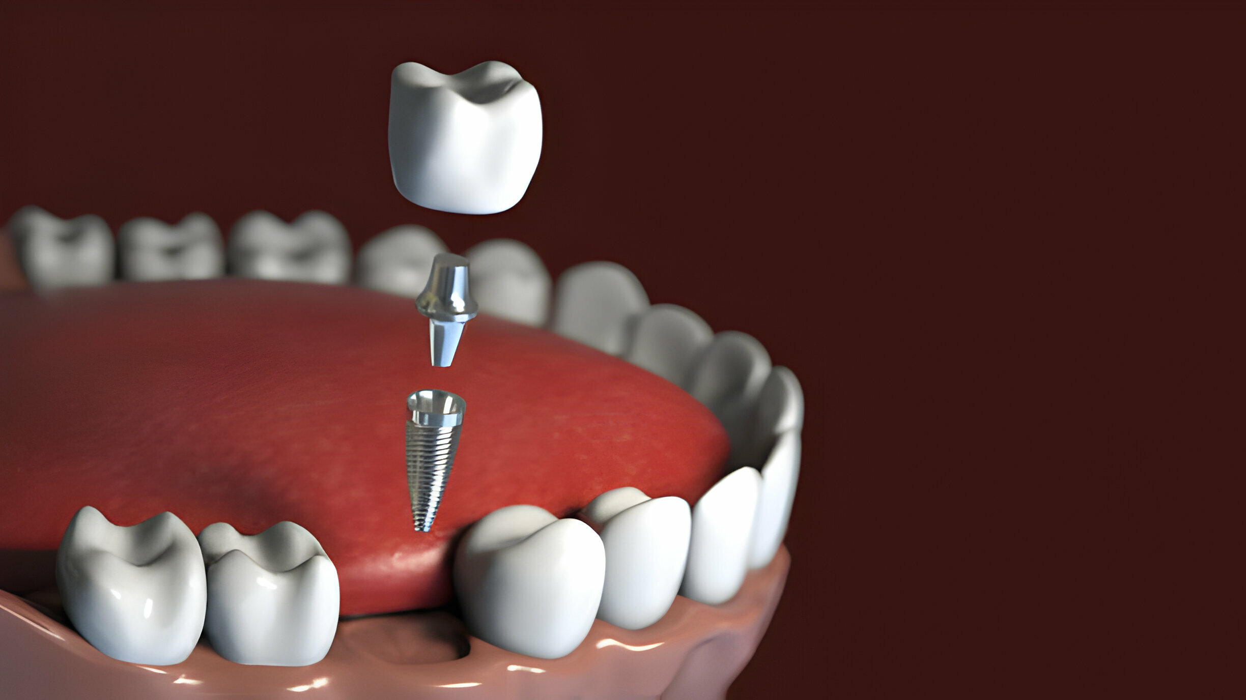 What to Expect During Dental Implants in Frisco, TX_FI