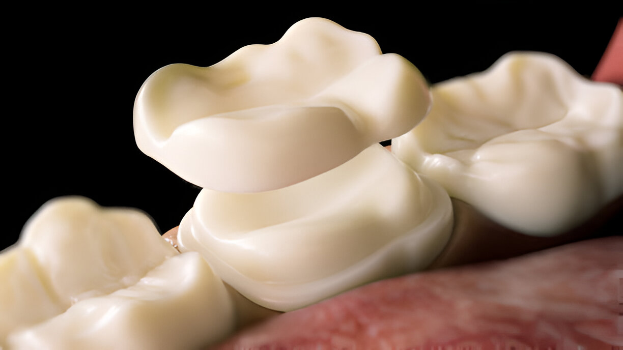 Explore Dental Sealants in Frisco, TX: Recommendations from the Best Dentist at Dental Arts of Frisco_FI