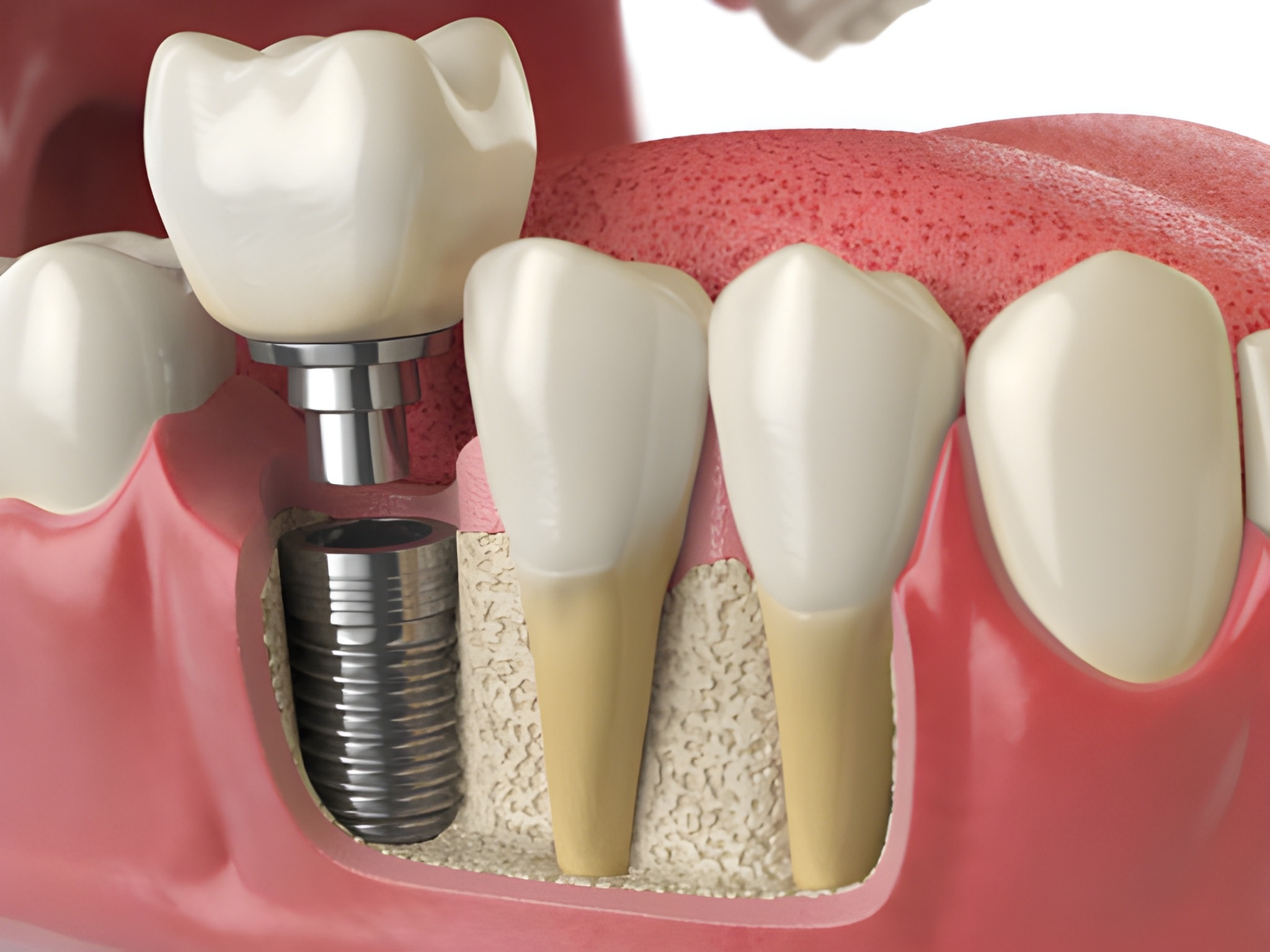 What to Expect During the Recovery Process After Dental Implants in Frisco, TX_FI
