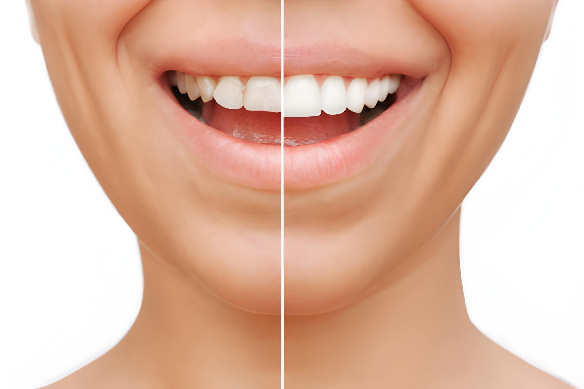 Smile Makeovers with Porcelain Veneers: A Complete Guide for Frisco Patients_FI