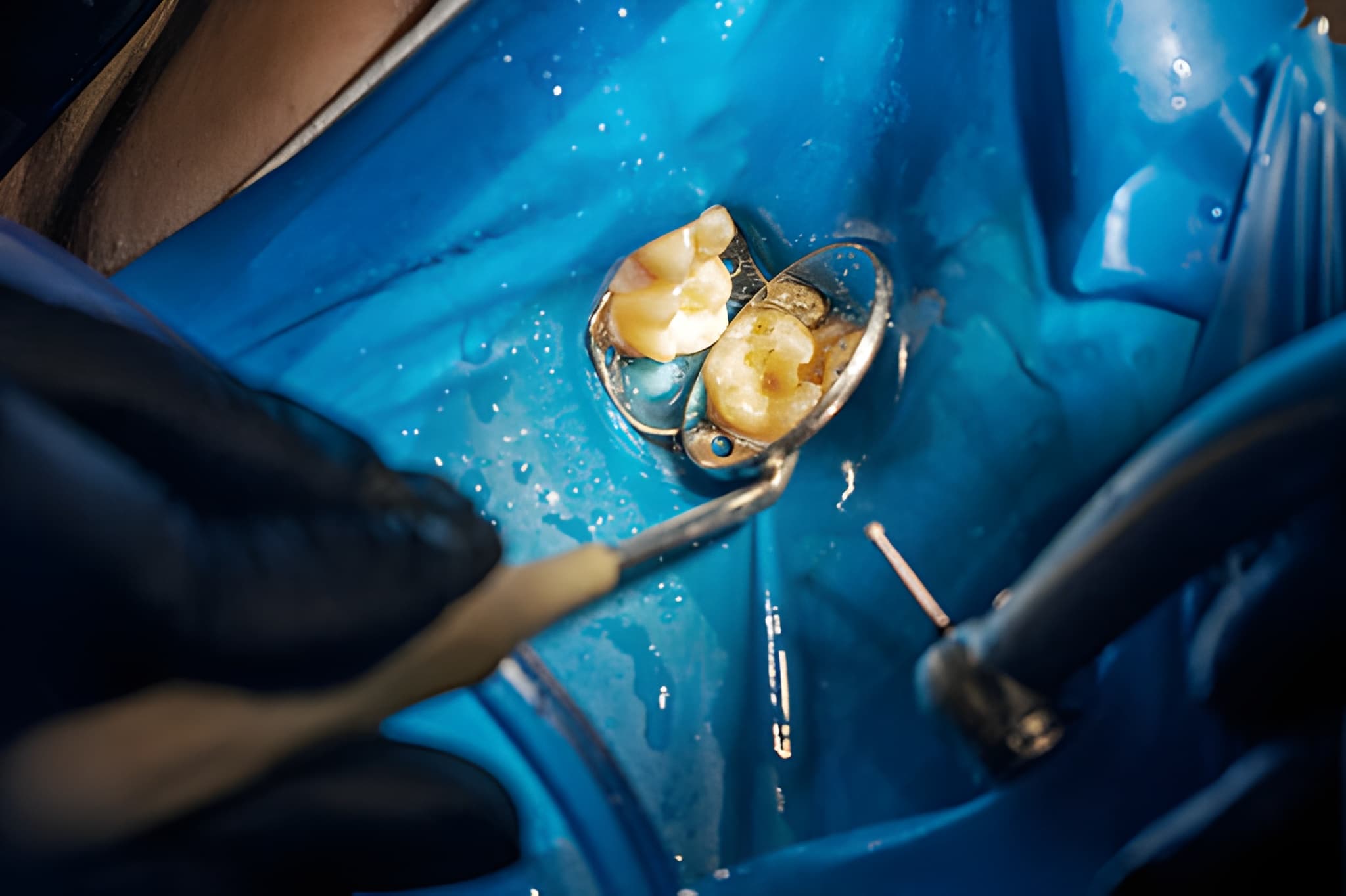 How Dental Arts of Frisco Makes Tooth Extractions Comfortable and Stress-Free_FI